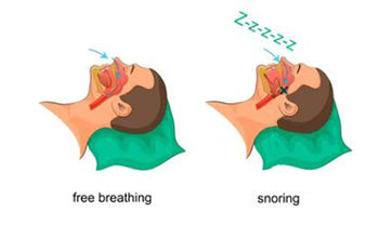 The Causes of Snoring | BMC CPAP Shop